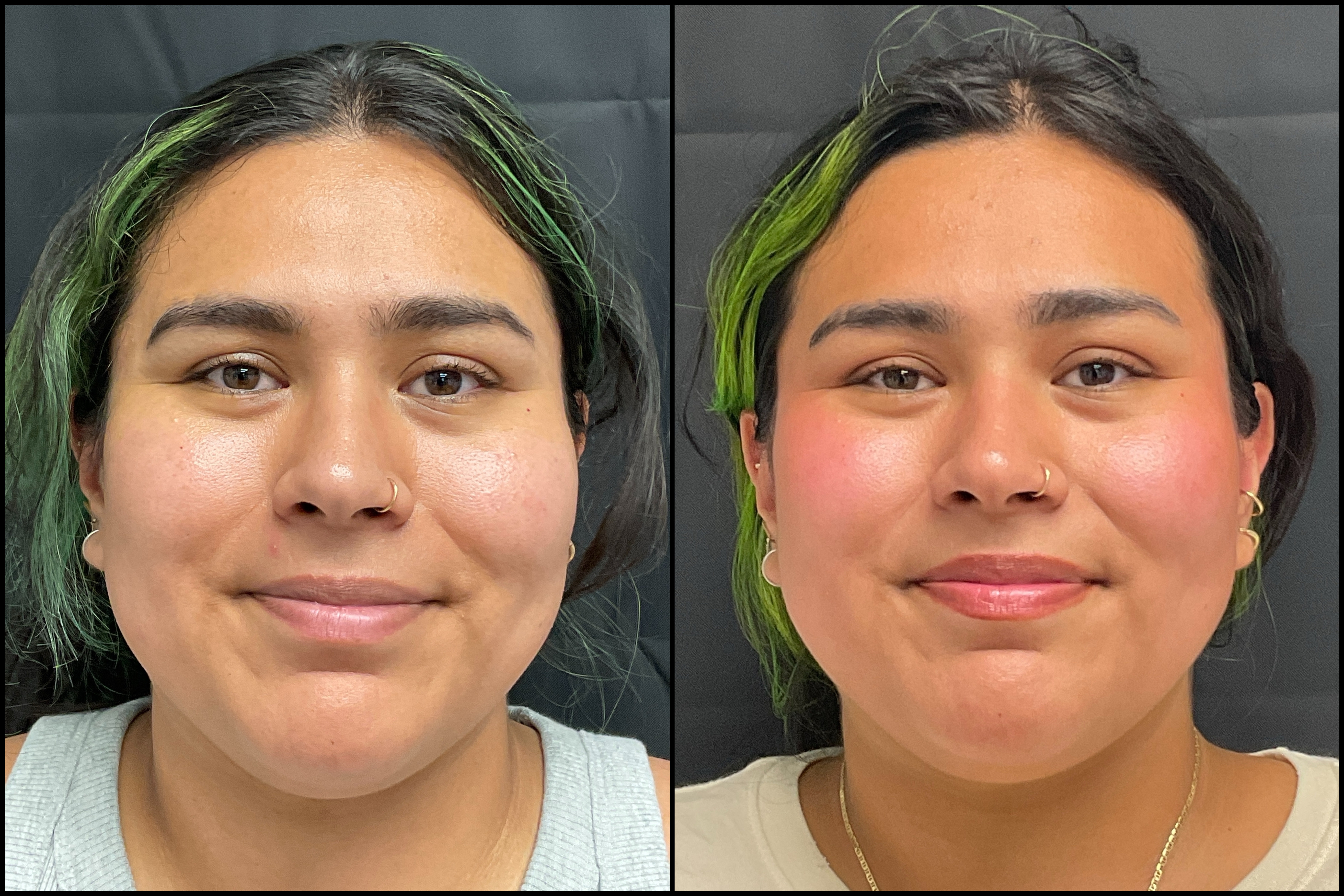 neurotoxin_storis-aesthetics_101899