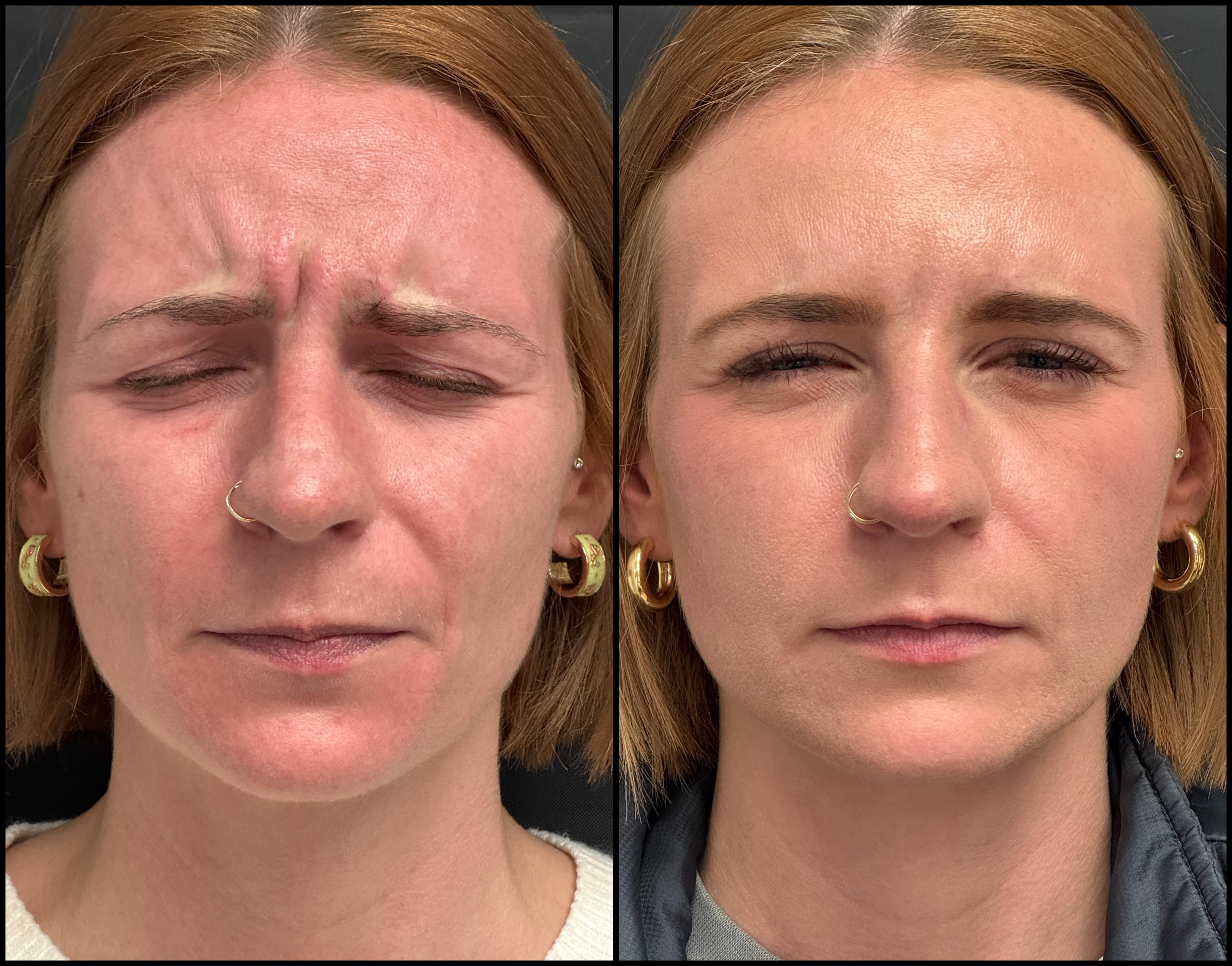 neurotoxin_storis-aesthetics_108351