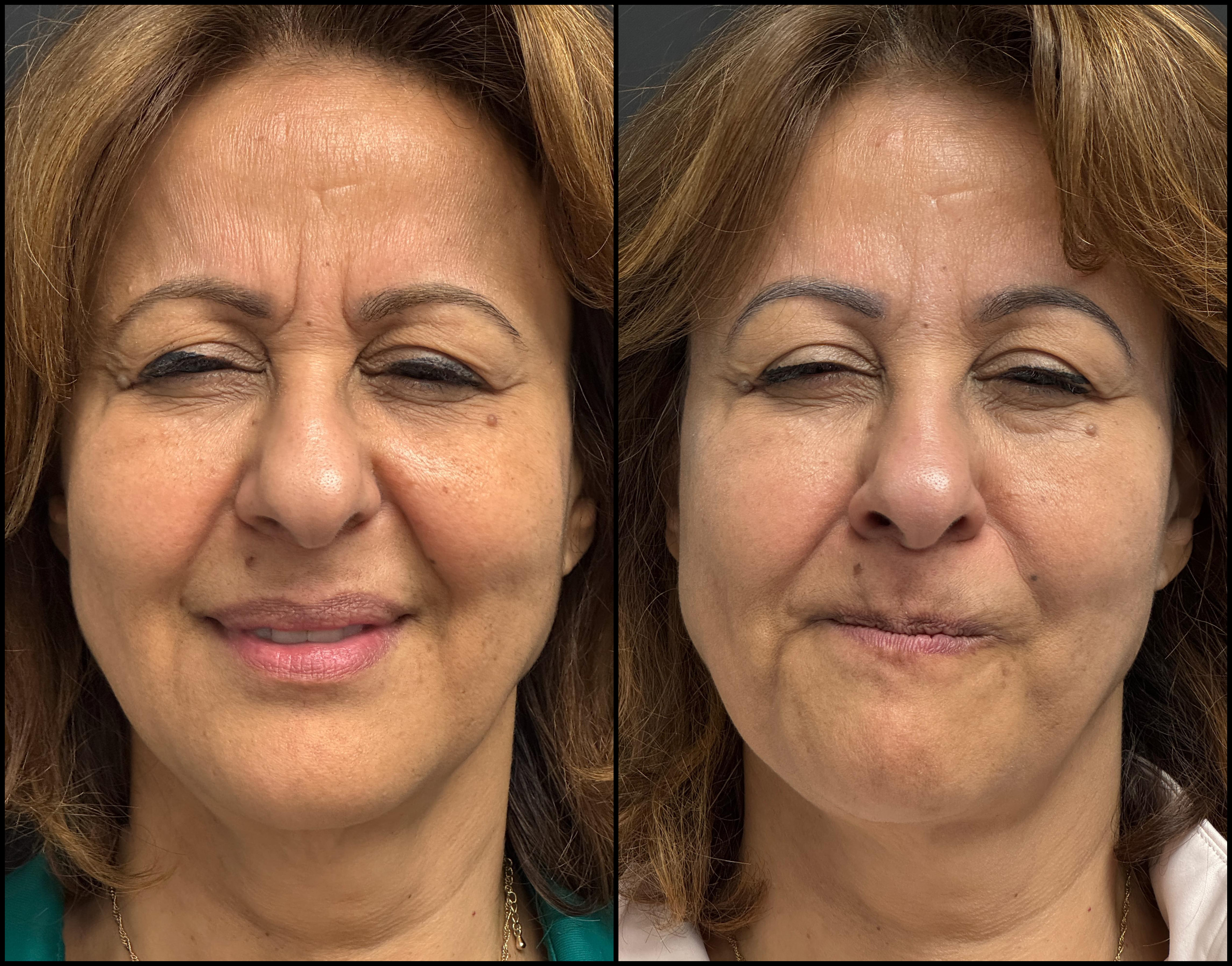 neurotoxin_storis-aesthetics_108675