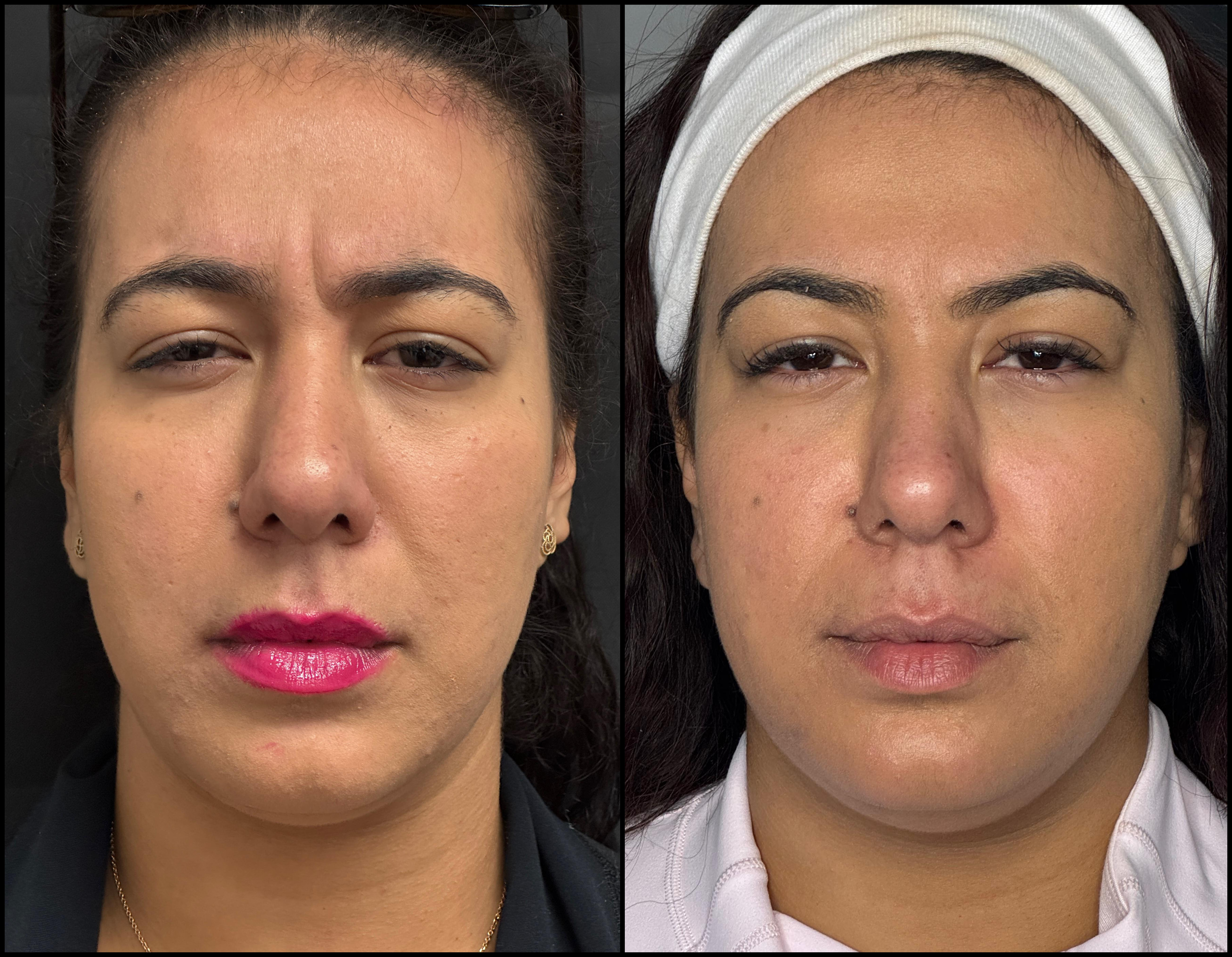 neurotoxin_storis-aesthetics_109725