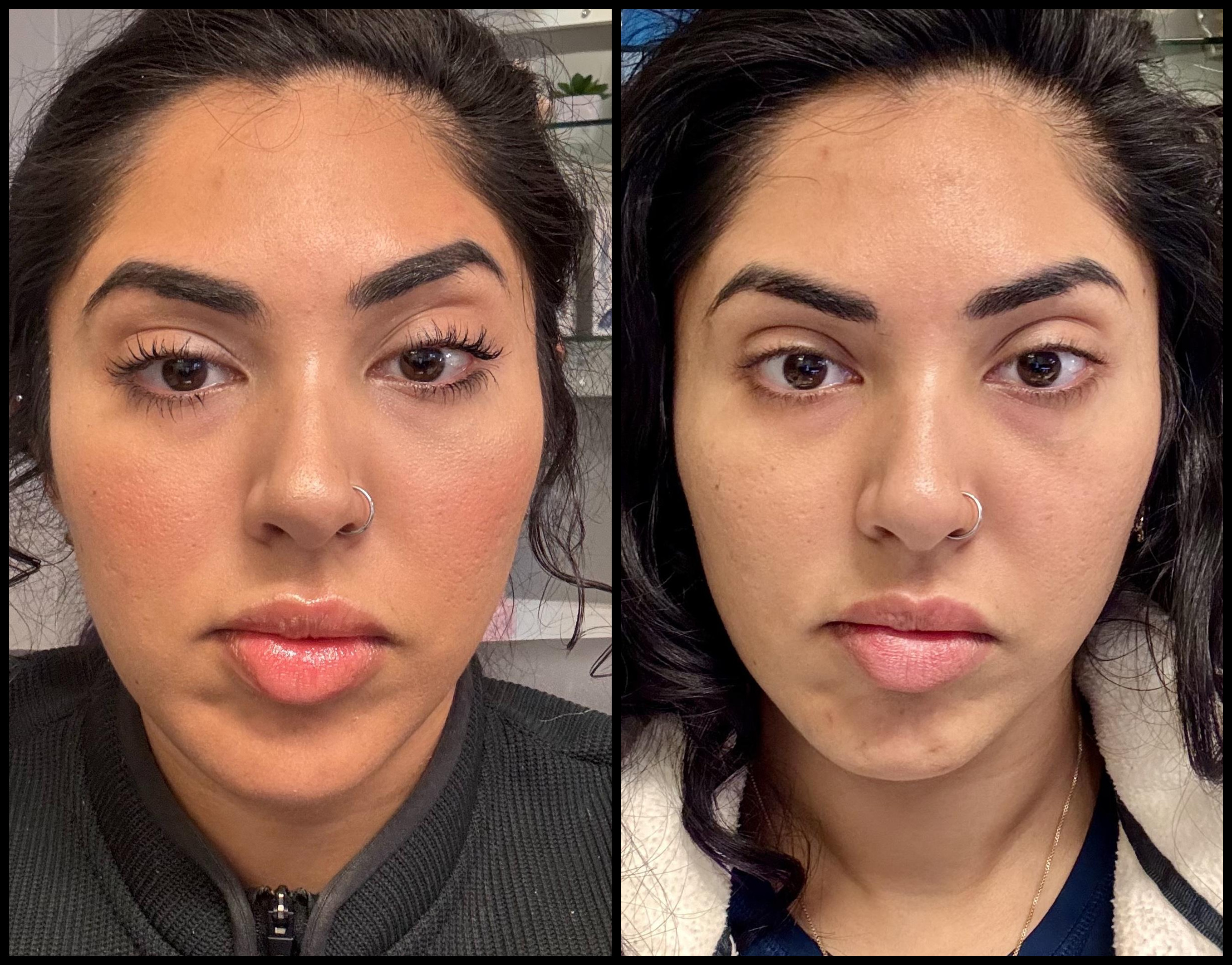 neurotoxin_storis-aesthetics_108350