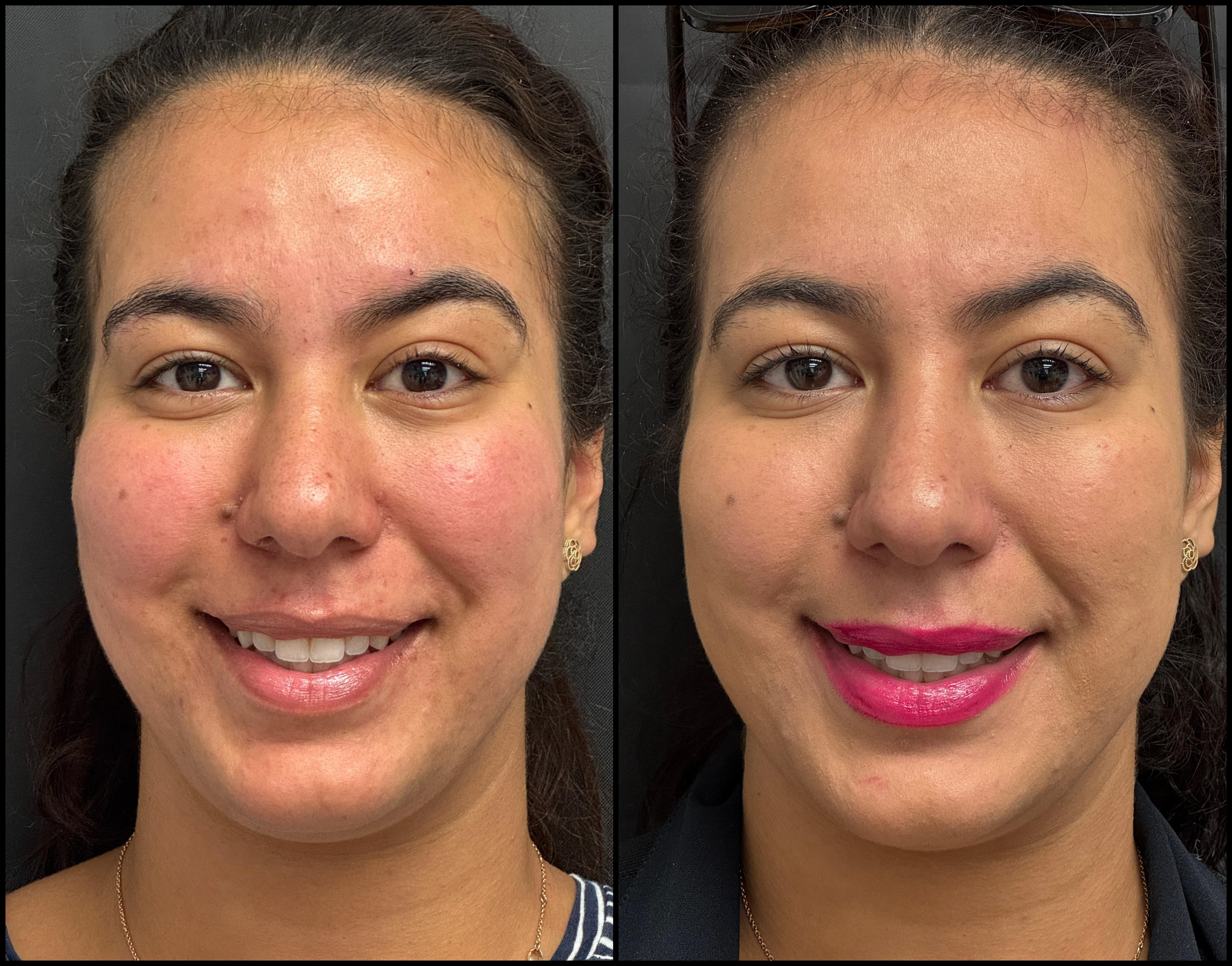 neurotoxin_storis-aesthetics_108676