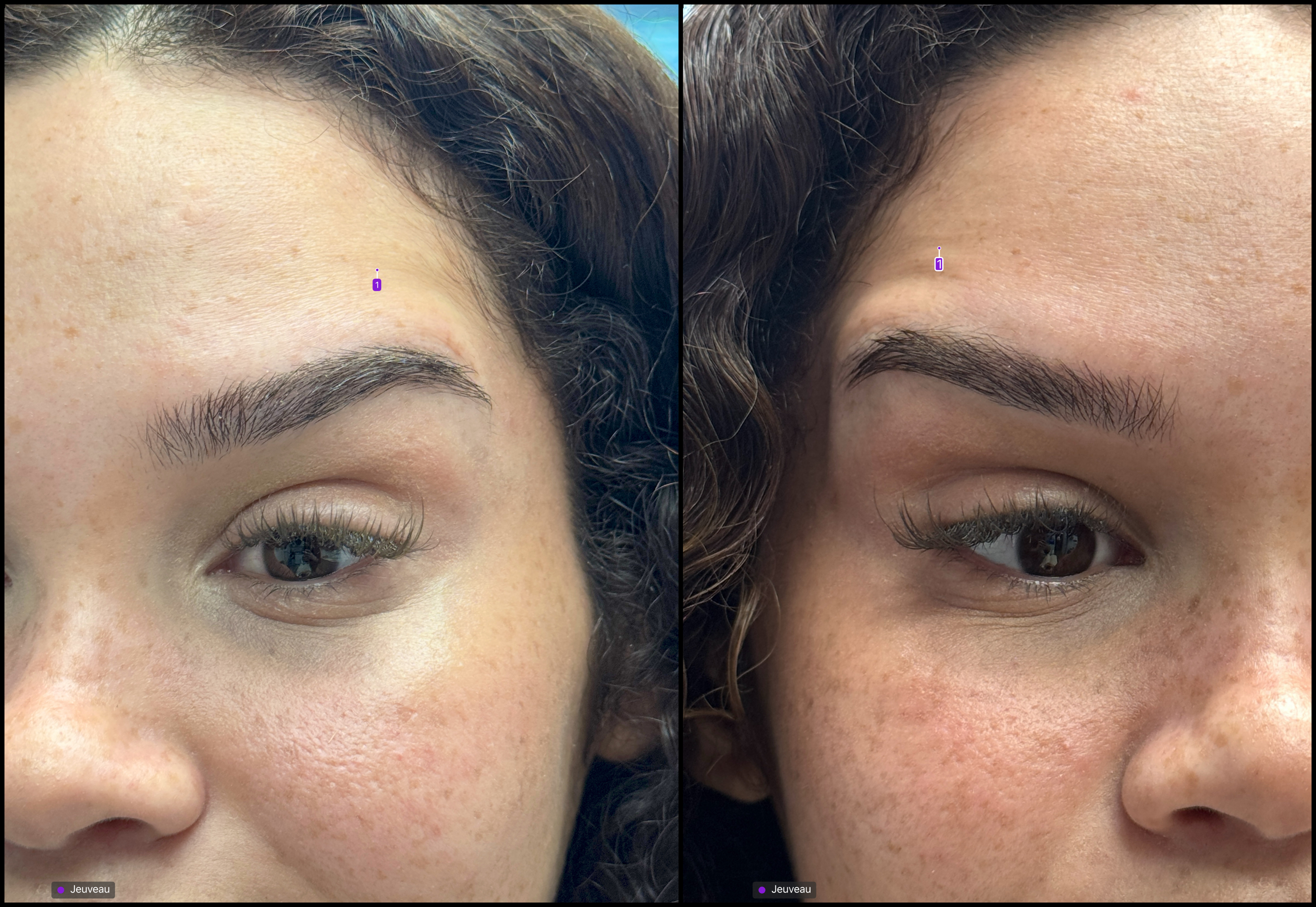 neurotoxin_storis-aesthetics_112333